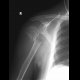 Fracture of colum chirurgicum of humerus: X-ray - Plain radiograph